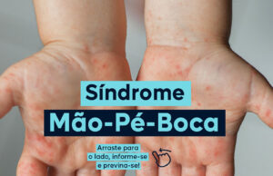 Síndrome mão-pé-boca